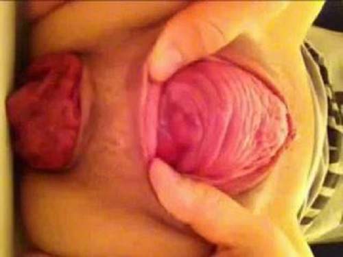 Amateur mature colossal cervix and prolapse anus