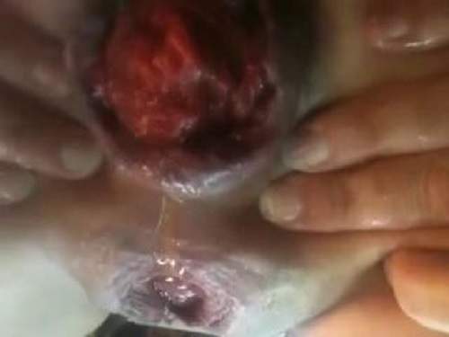 Prolapse ass – Amateur slut with huge anal rosebutt closeup play