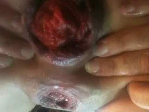 Prolapse – Incredible homemade very closeup huge prolapse anal penetrate