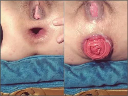 Anal prolapse – Perverted girl Vixenxmoon fingering her beautiful anal prolapse